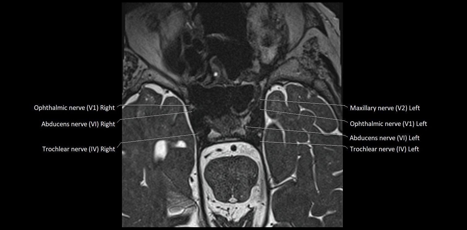 Cranial nerve anatomy axial MRI 3T image 31.webp